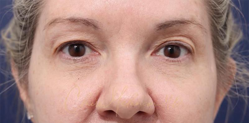 Blepharoplasty Before & After Photo