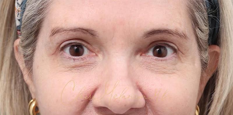 Blepharoplasty Before & After Photo