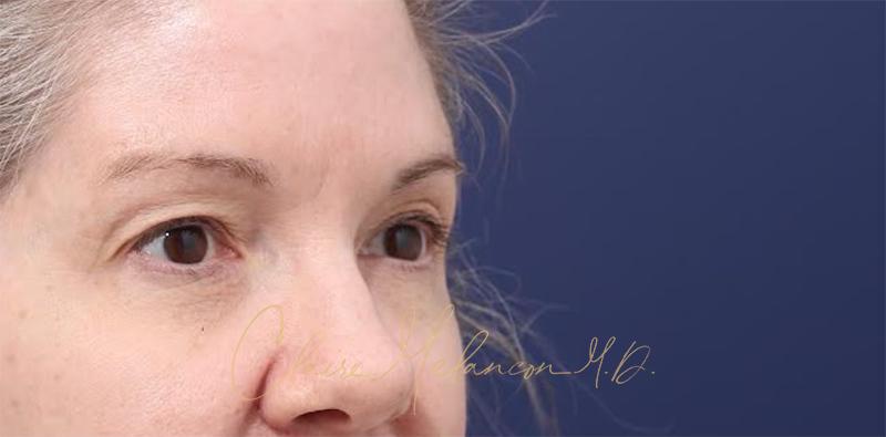 Blepharoplasty Before & After Photo