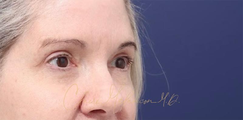 Blepharoplasty Before & After Photo