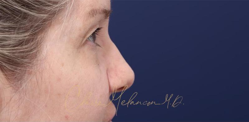 Blepharoplasty Before & After Photo