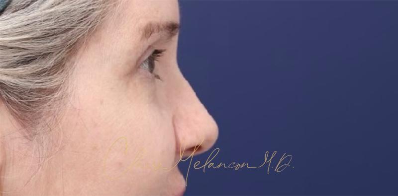 Blepharoplasty Before & After Photo