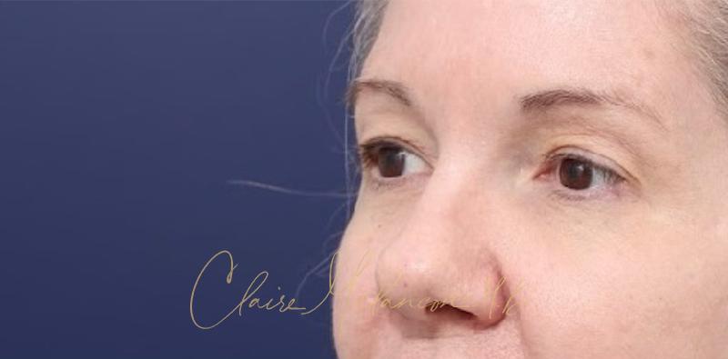 Blepharoplasty Before & After Photo
