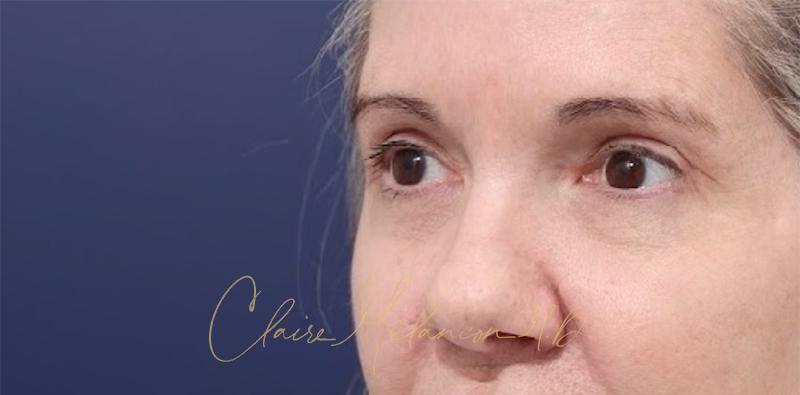 Blepharoplasty Before & After Photo