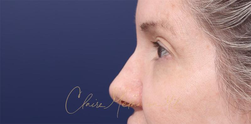 Blepharoplasty Before & After Photo