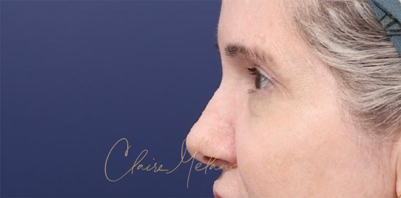 Blepharoplasty Before & After Photo