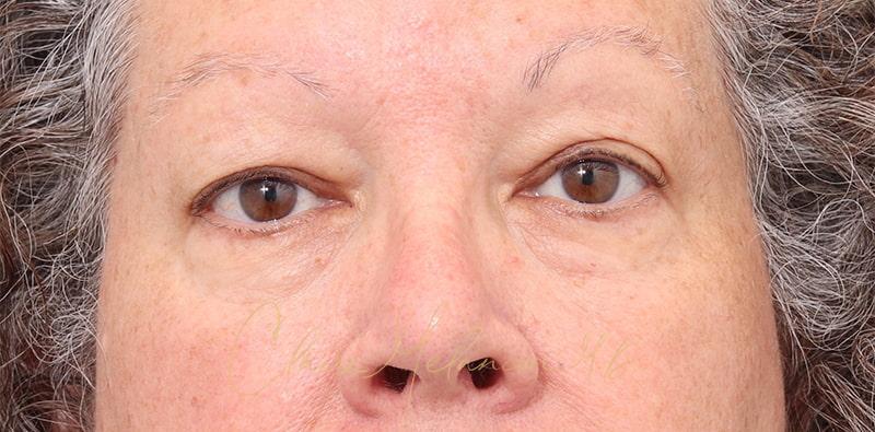 Blepharoplasty Before & After Photo