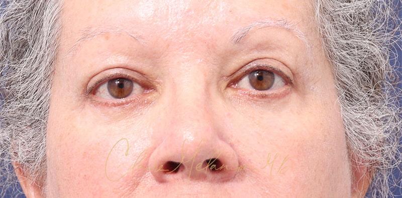 Blepharoplasty Before & After Photo