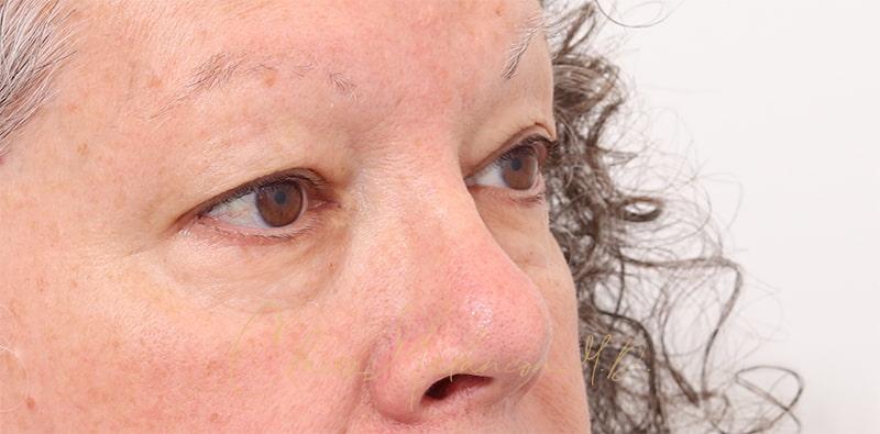 Blepharoplasty Before & After Photo