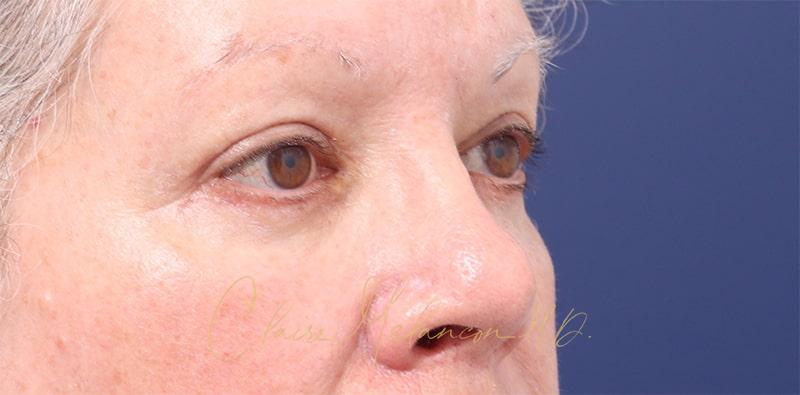 Blepharoplasty Before & After Photo