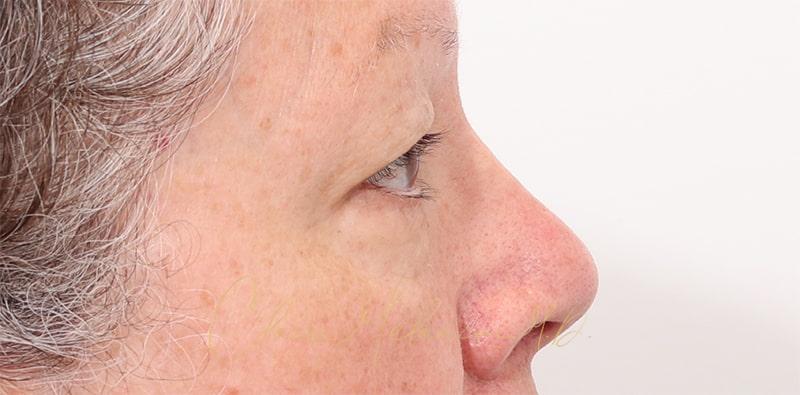 Blepharoplasty Before & After Photo