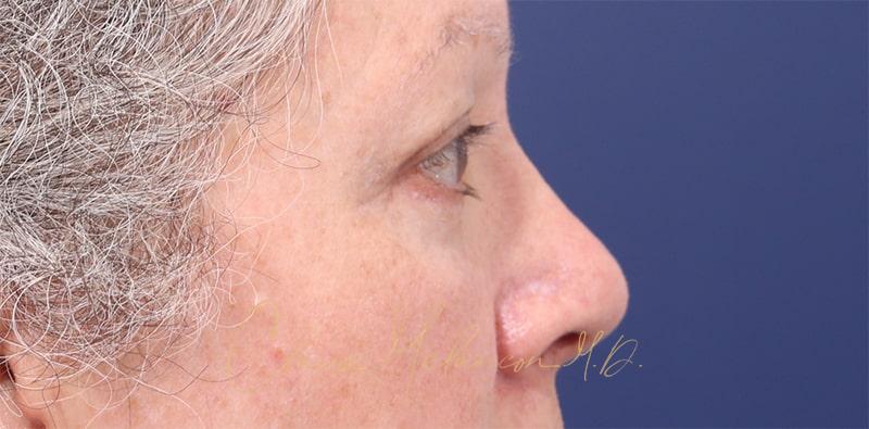 Blepharoplasty Before & After Photo