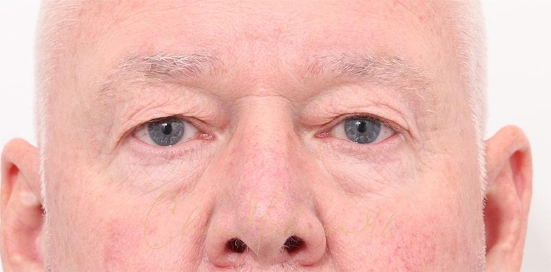 Blepharoplasty Before & After Photo