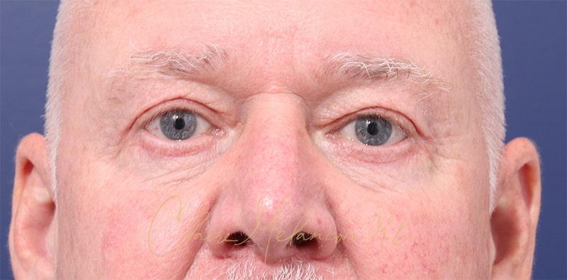 Blepharoplasty Before & After Photo