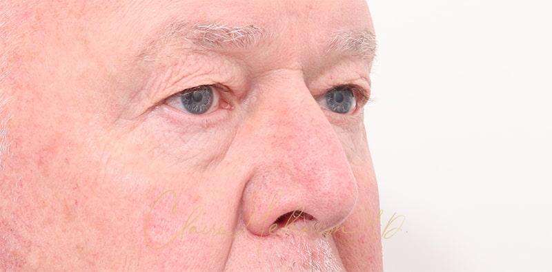 Blepharoplasty Before & After Photo