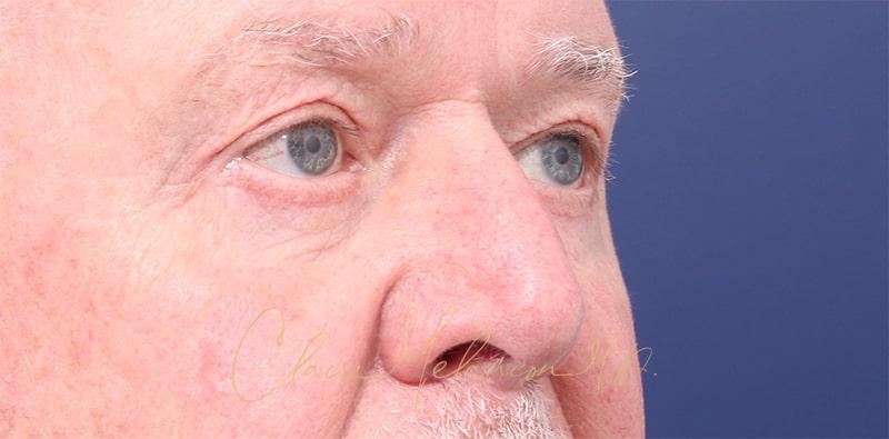 Blepharoplasty Before & After Photo