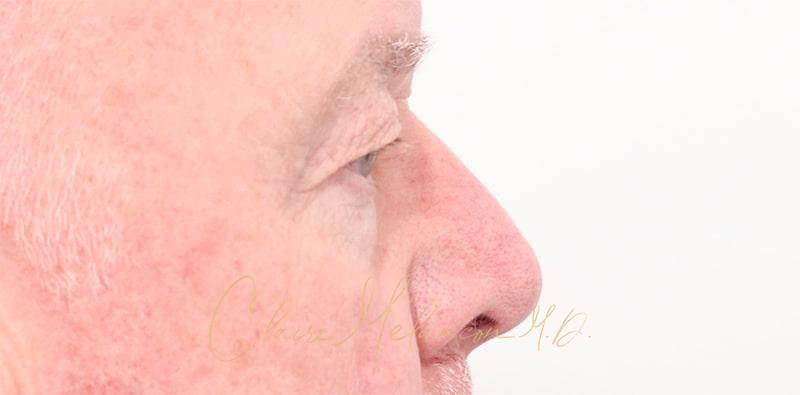 Blepharoplasty Before & After Photo