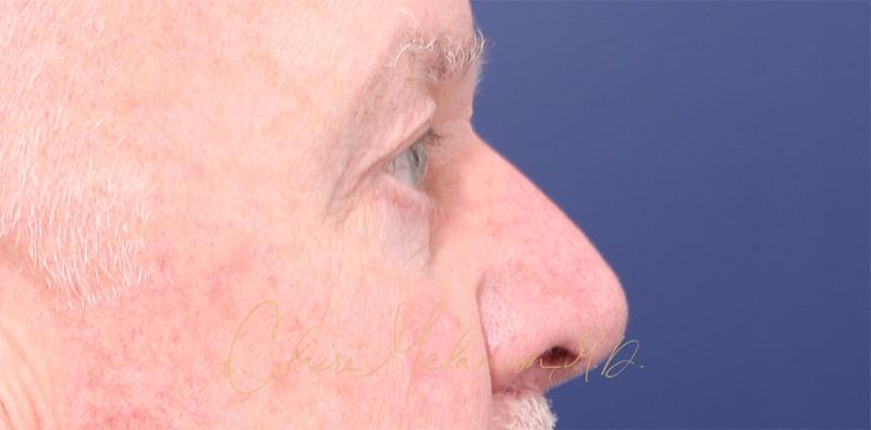 Blepharoplasty Before & After Photo