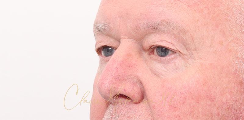 Blepharoplasty Before & After Photo