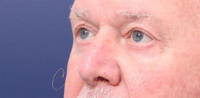 Blepharoplasty Before & After Photo