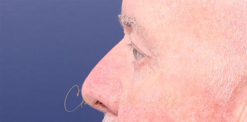 Blepharoplasty Before & After Photo
