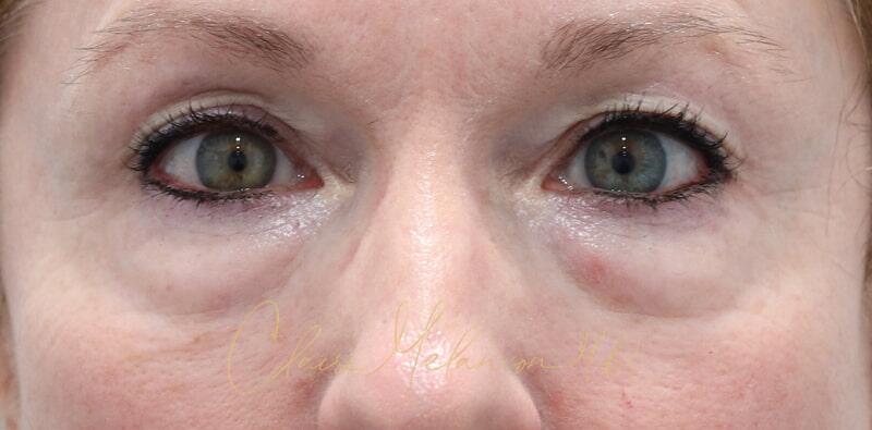 Blepharoplasty Before & After Photo