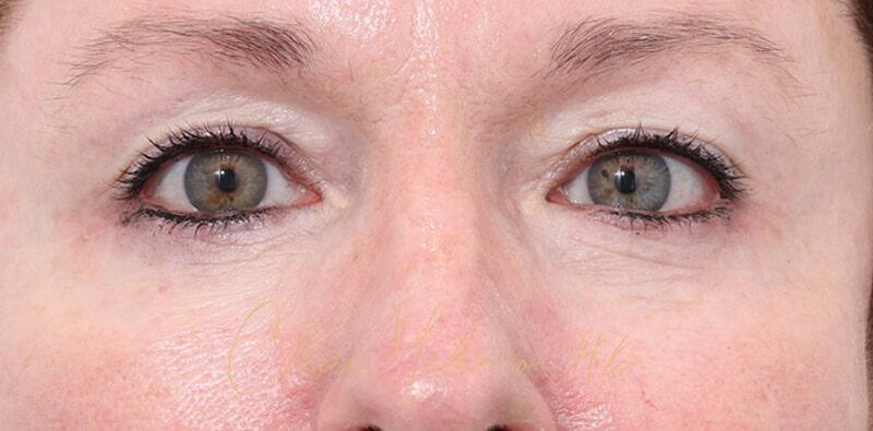 Blepharoplasty Before & After Photo