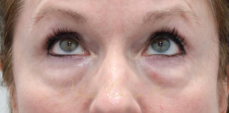 Blepharoplasty Before & After Photo
