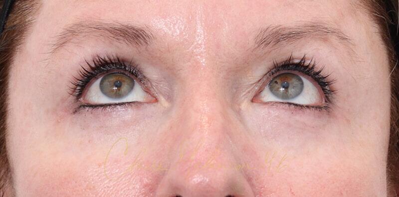 Blepharoplasty Before & After Photo