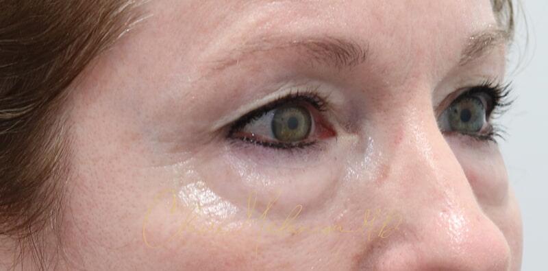 Blepharoplasty Before & After Photo