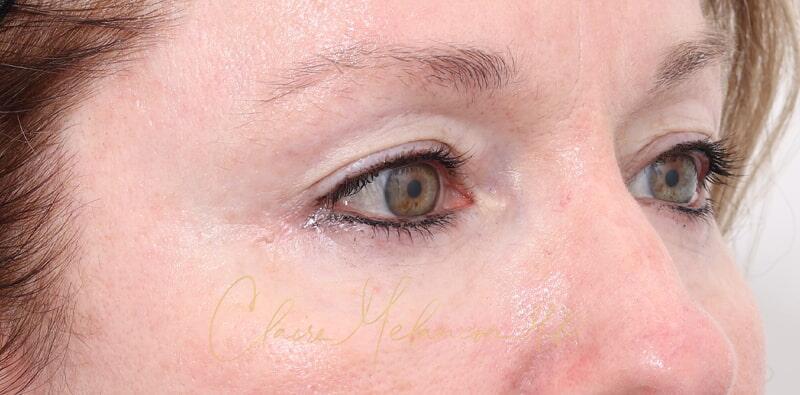 Blepharoplasty Before & After Photo