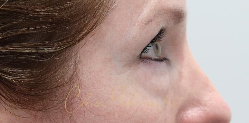 Blepharoplasty Before & After Photo