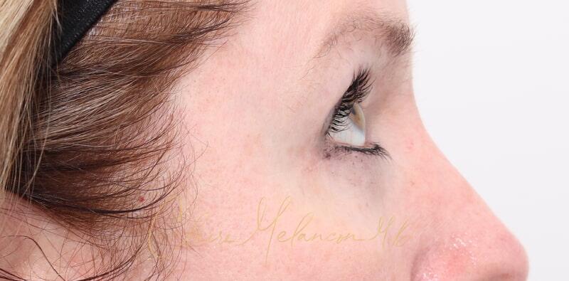 Blepharoplasty Before & After Photo
