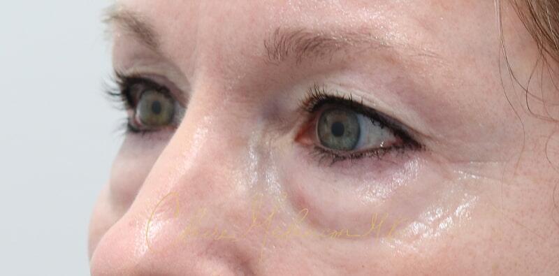 Blepharoplasty Before & After Photo