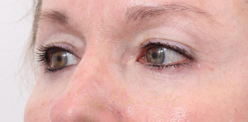 Blepharoplasty Before & After Photo