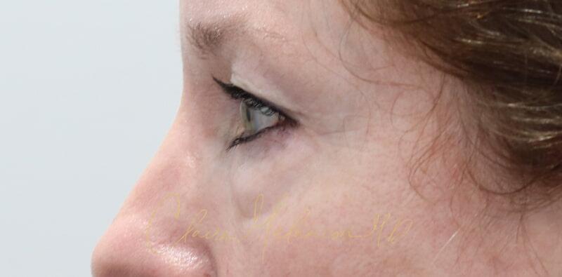 Blepharoplasty Before & After Photo