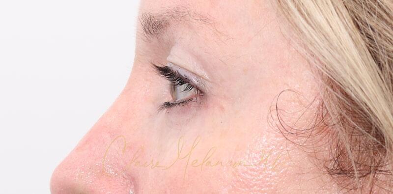 Blepharoplasty Before & After Photo
