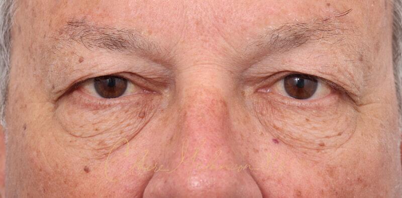 Blepharoplasty Before & After Photo