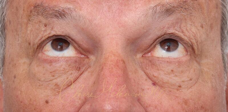 Blepharoplasty Before & After Photo