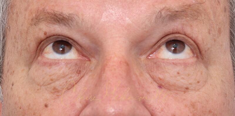 Blepharoplasty Before & After Photo