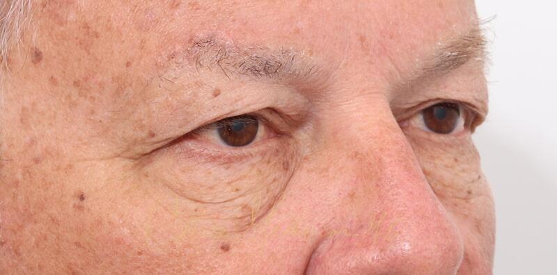 Blepharoplasty Before & After Photo