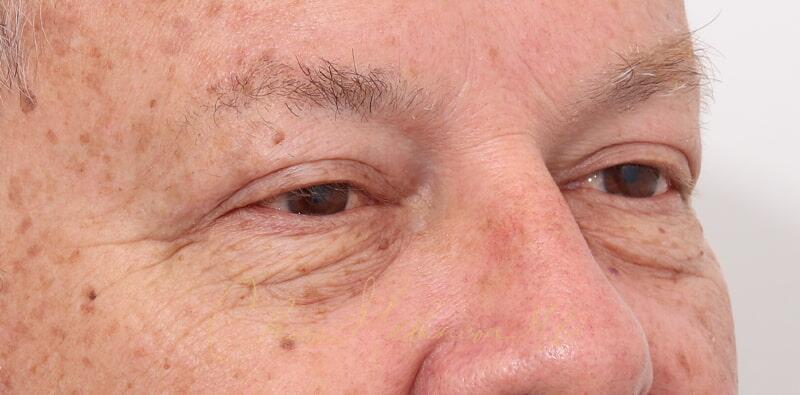 Blepharoplasty Before & After Photo