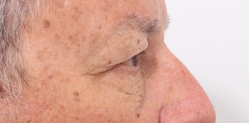 Blepharoplasty Before & After Photo