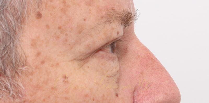 Blepharoplasty Before & After Photo