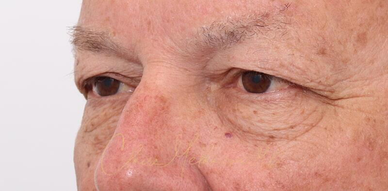 Blepharoplasty Before & After Photo