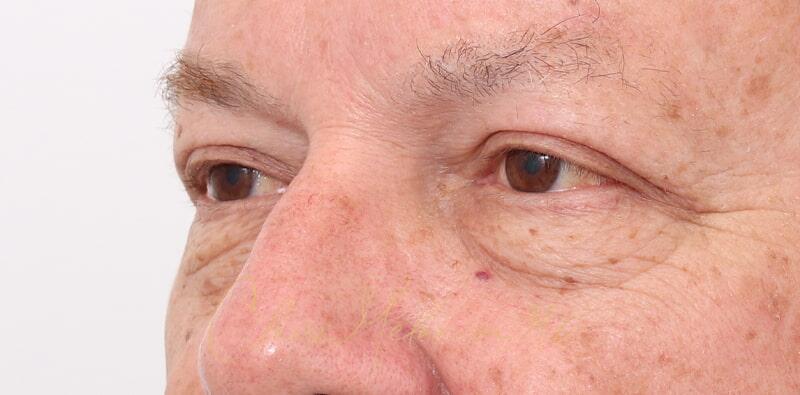 Blepharoplasty Before & After Photo