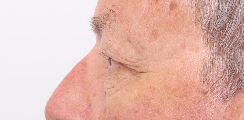 Blepharoplasty Before & After Photo