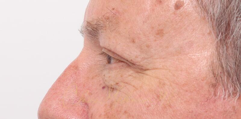 Blepharoplasty Before & After Photo