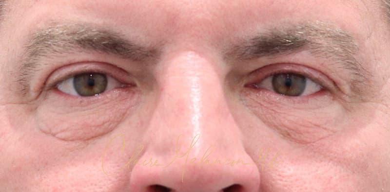 Blepharoplasty Before & After Photo