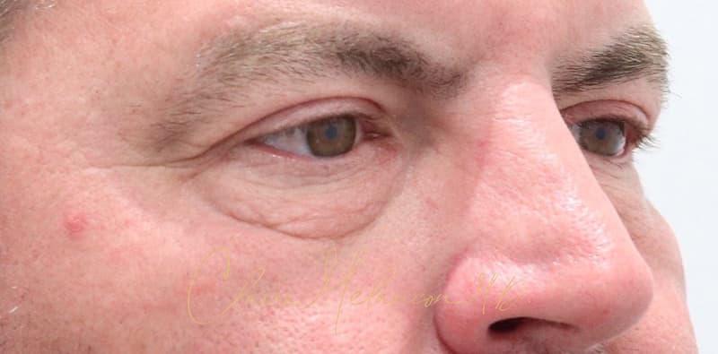 Blepharoplasty Before & After Photo